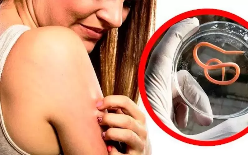 Juckreiz und Reizungen aufgrund von Parasiten im Körper