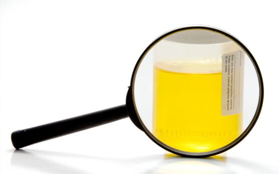 Urinuntersuchung zur Diagnose einer Bilharziose